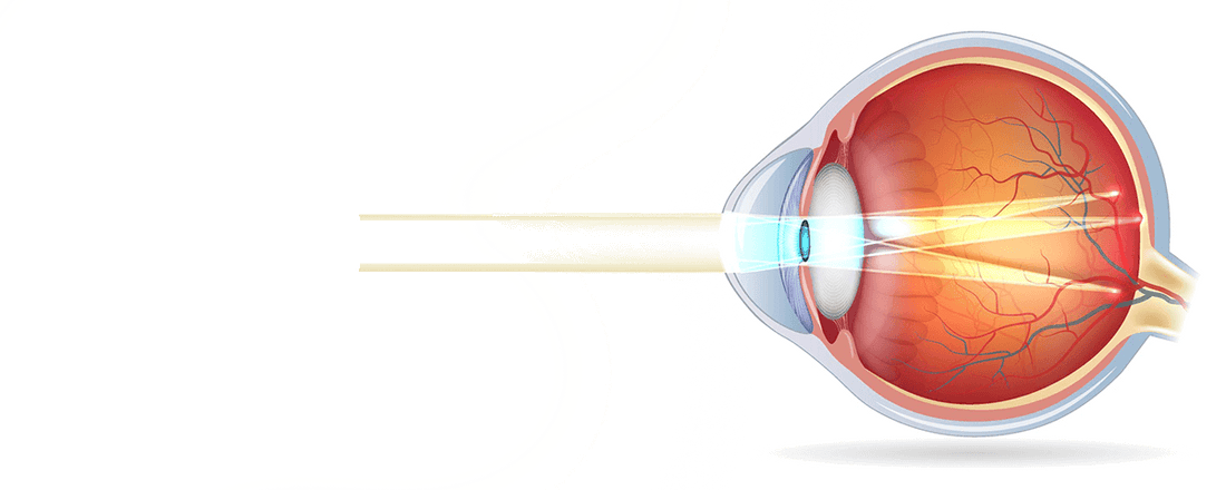 Que es la miopia el astigmatismo y la presbicie o hipermetropia que diferencias hay y como ve una persona