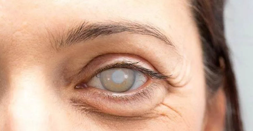 ¿Qué son las cataras y qué tratamientos existen?